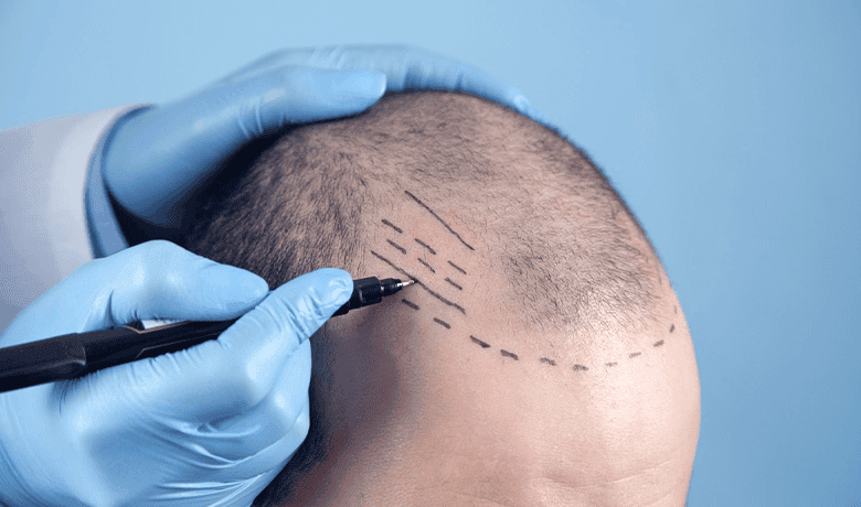 Hair Transplant Turkey Clinics