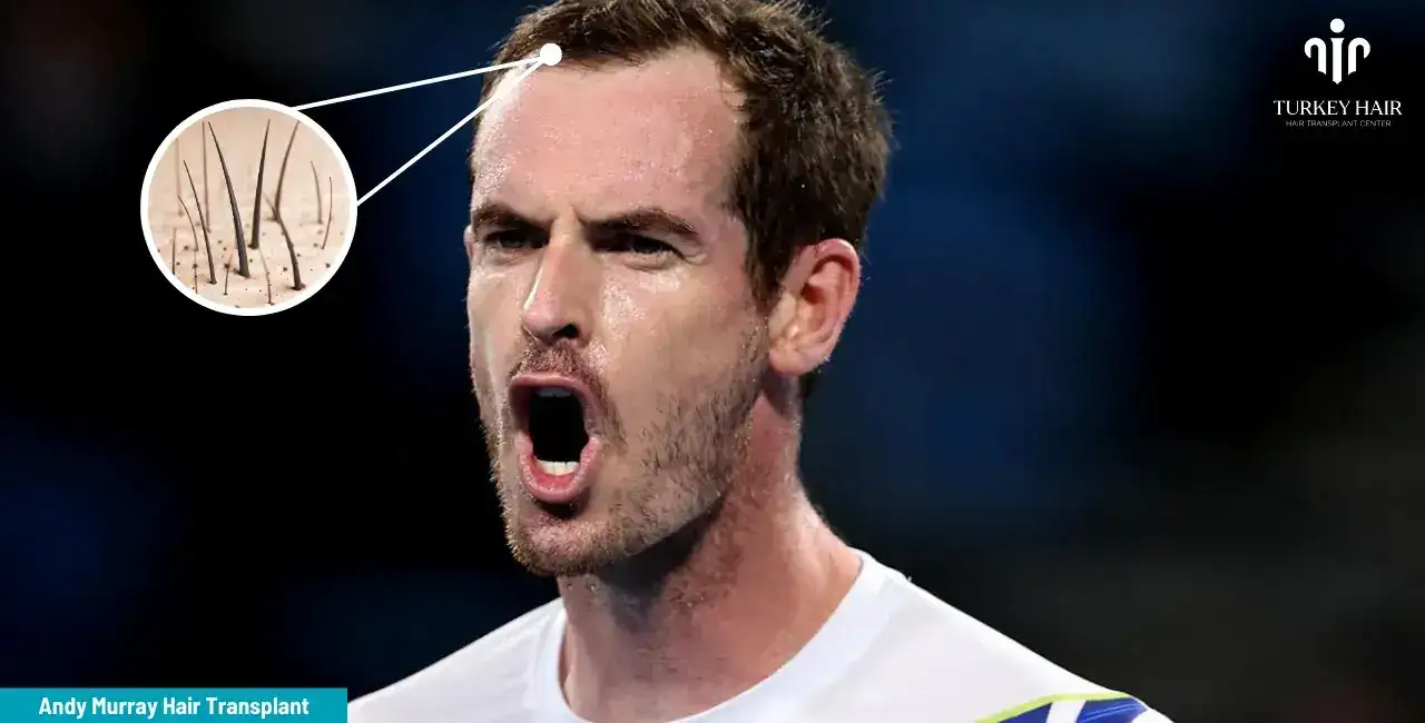 Andy Murray'S Hair Transplant: Before And After