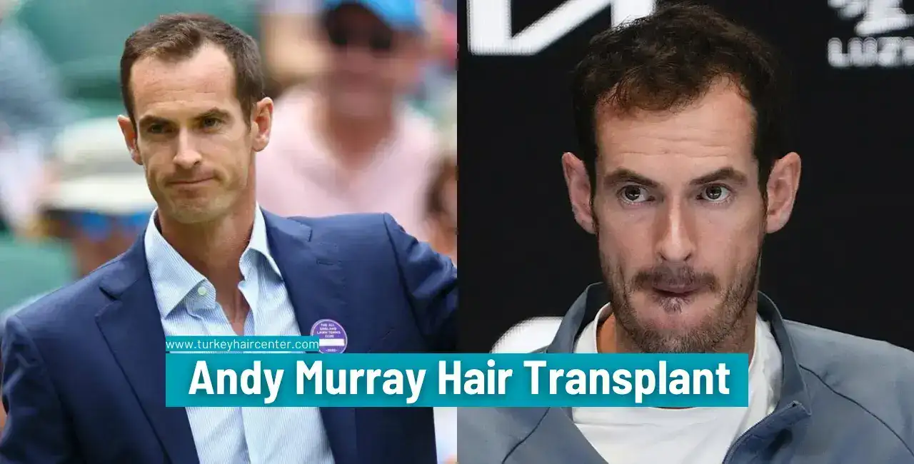 Andy Murray'S Hair Transplant