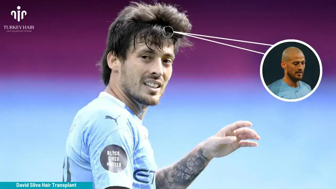 David Silva Hair Transplant Procedure Like David Silva Hair Transplant