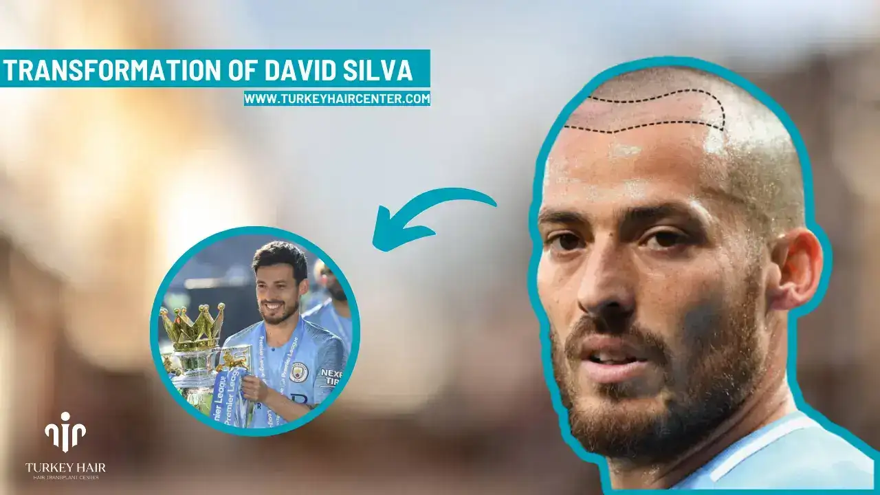 David-Silva-Hair-Transplant-3 David Silva Hair Transplant