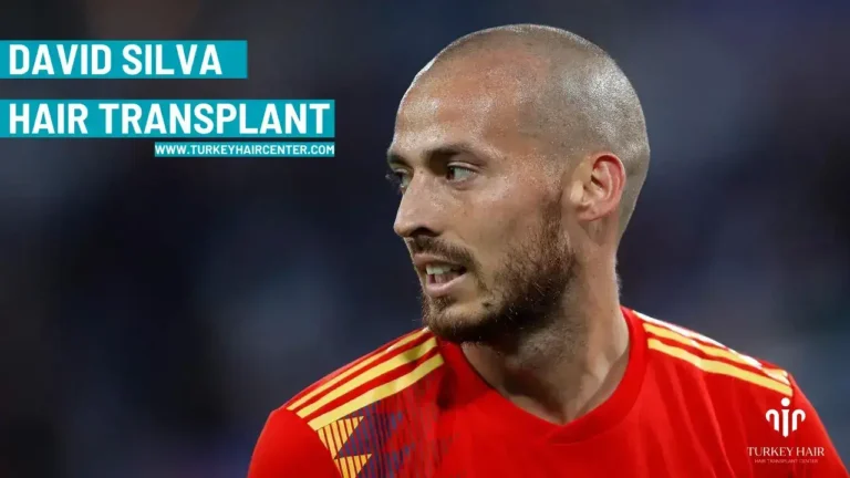 David Silva Hair Transplant In Turkey Hair Transplant