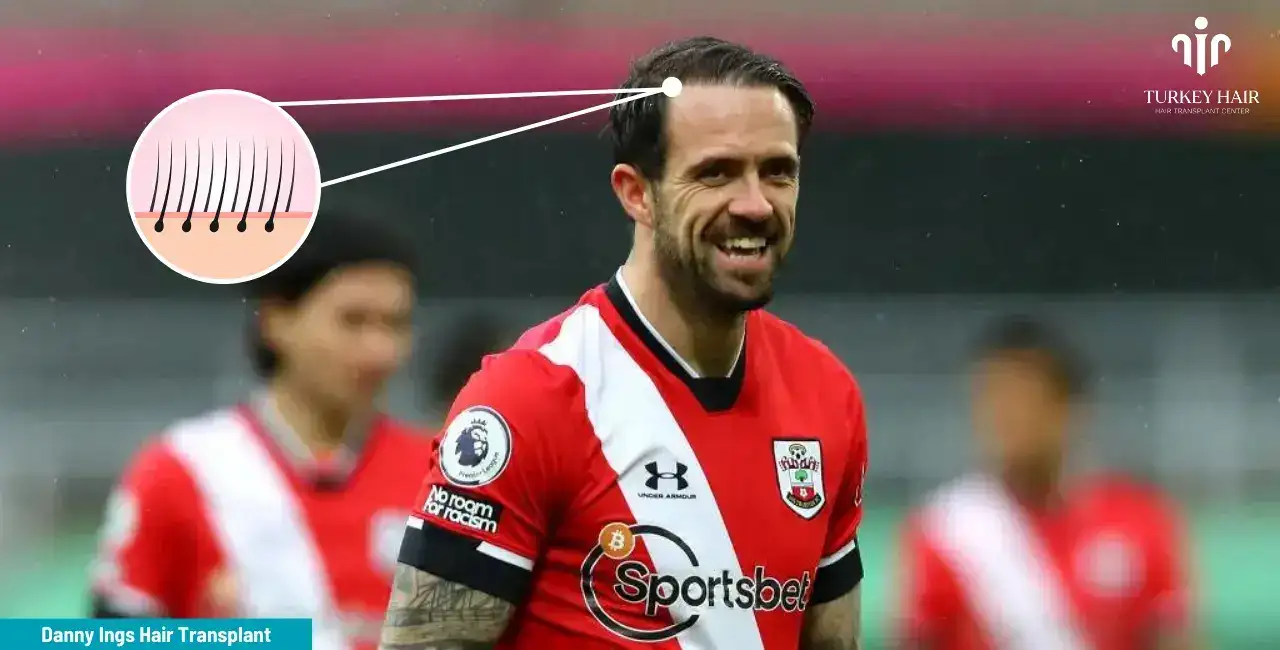 Hair Transplant For Danny Ings