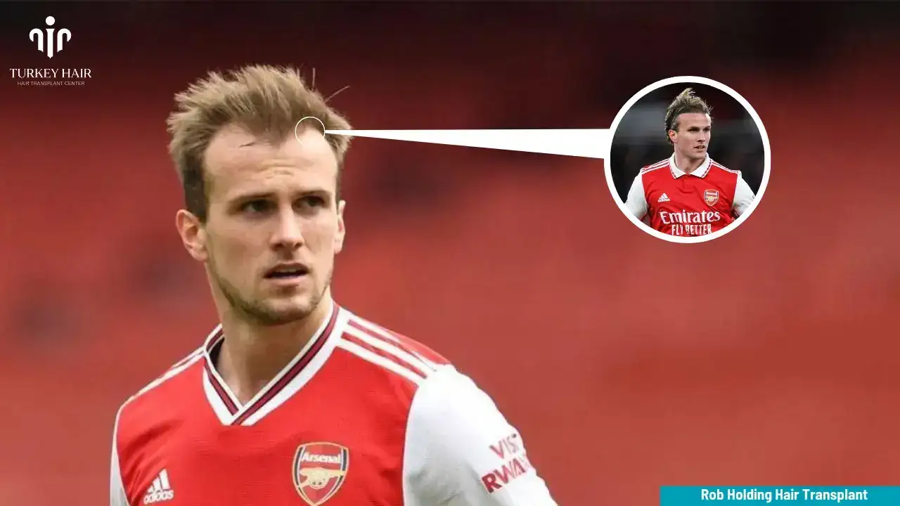Rob Holding Hair Transplant