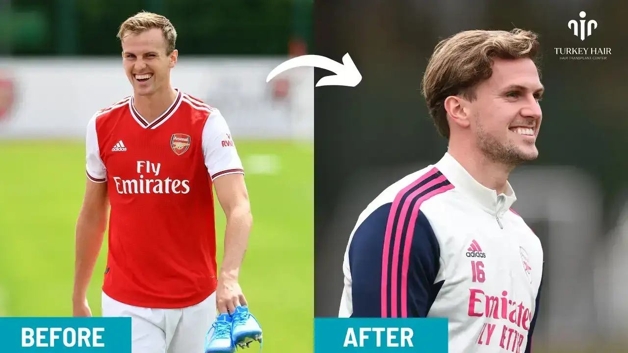 Hair Transplant Journey Of Rob Holding
