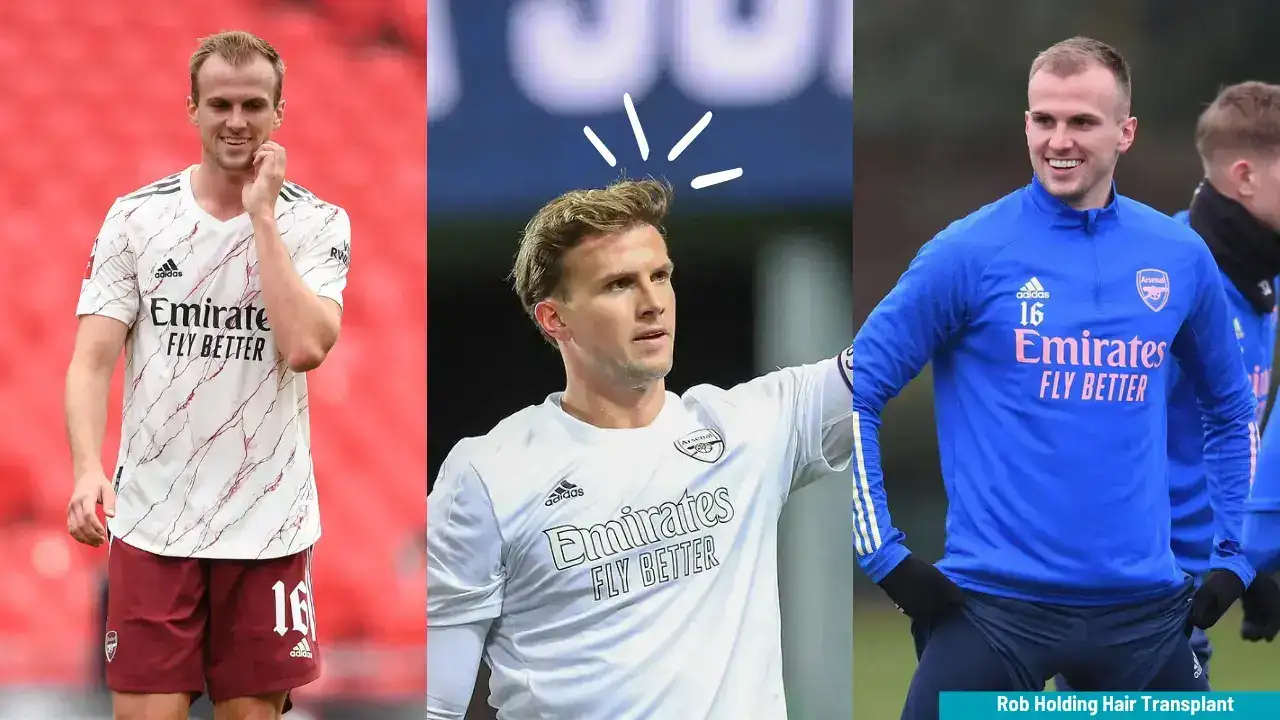 Comparative Analysis Of Rob Holding Hair Transplants
