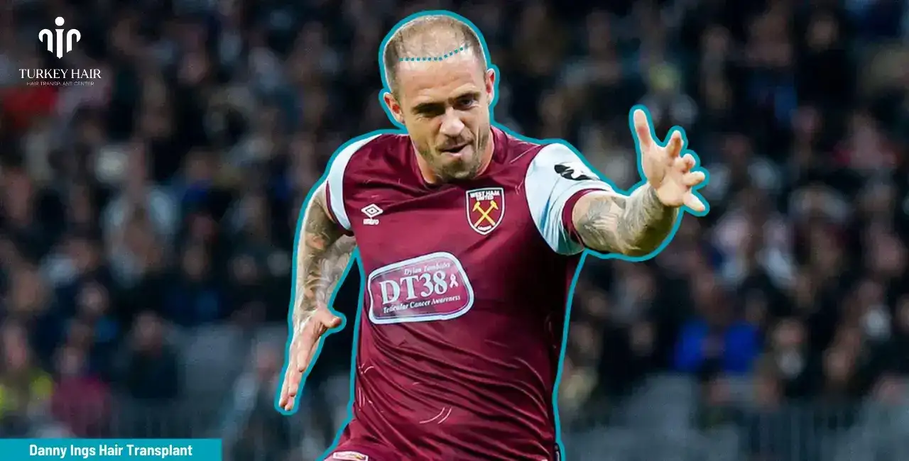 Investigating Danny Ings Hair Transplant