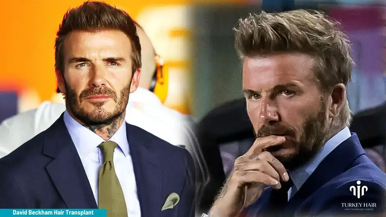 David Beckham Hair Transplant 1 (1) (1) David Beckham Hair Transplant