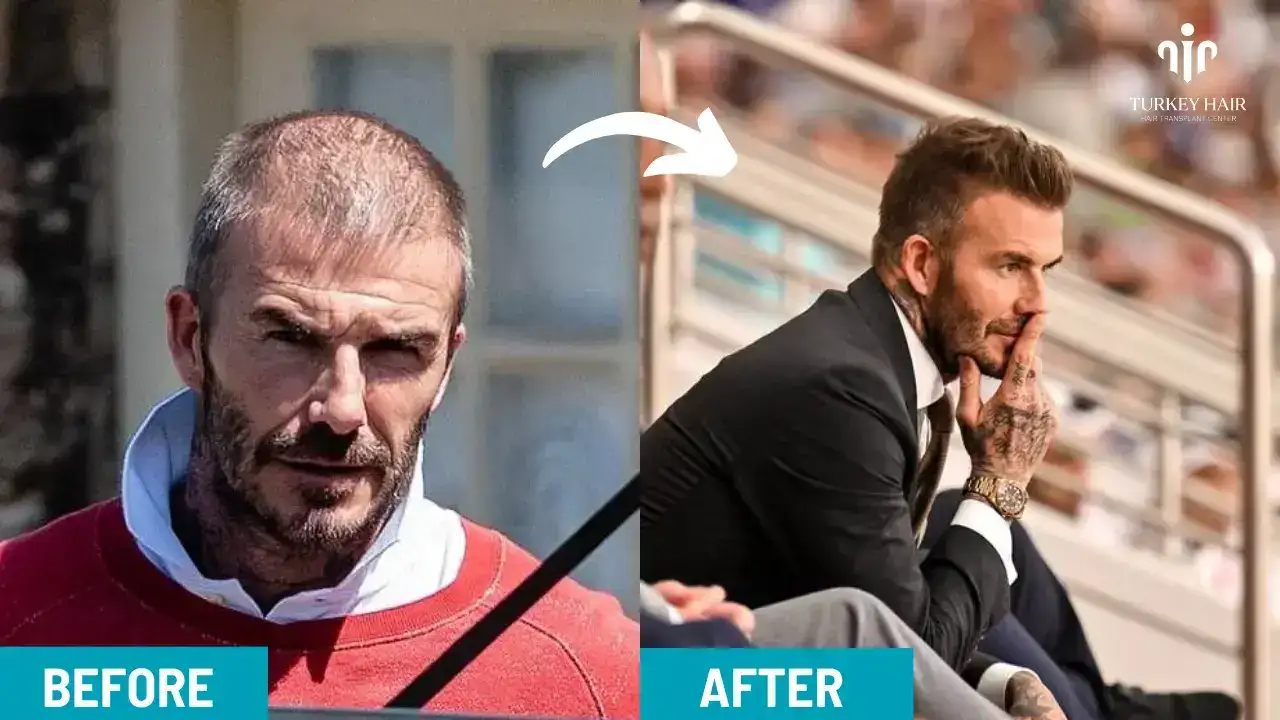 David Beckham Hair Transplant (1) (1) David Beckham Hair Transplant