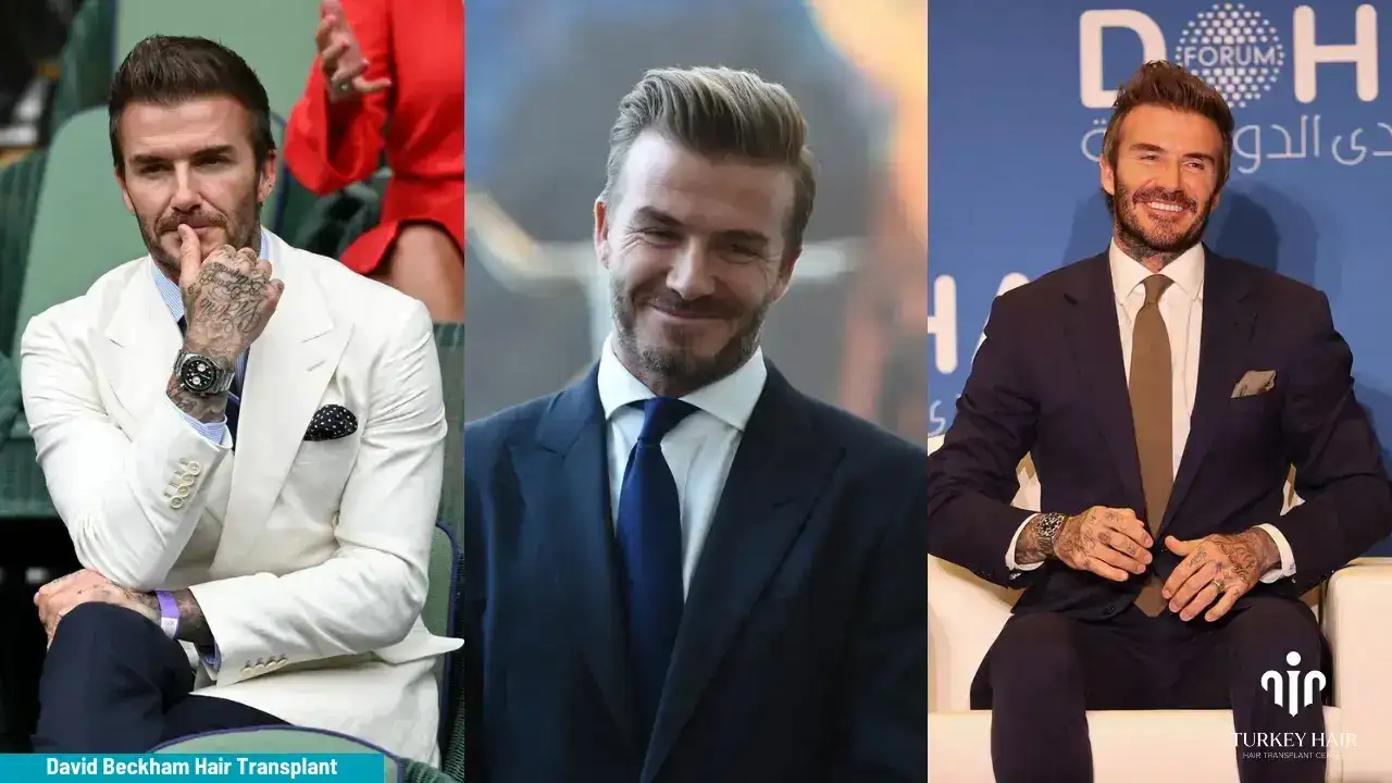 David Beckham Hair Transplant 1 (3) (1) David Beckham Hair Transplant