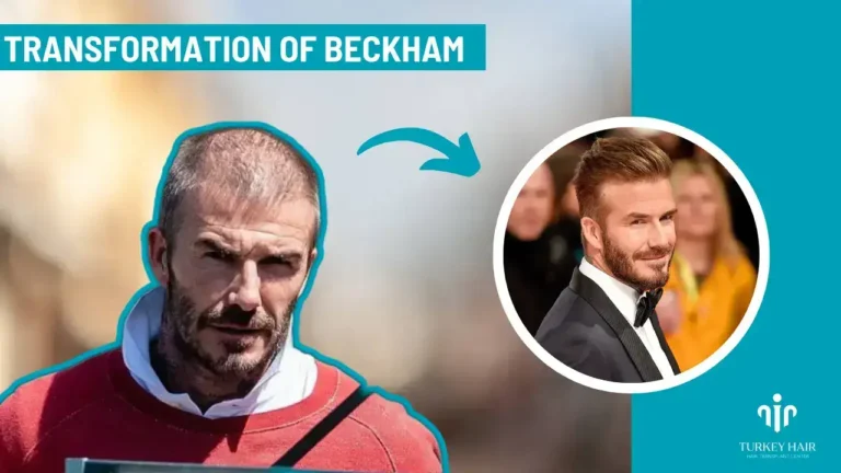 David Beckham Hair Transplant