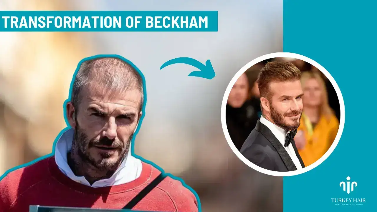 Unbelievably Story About David Beckham Hair Transplant 2026 1 David Beckham Hair Transplant