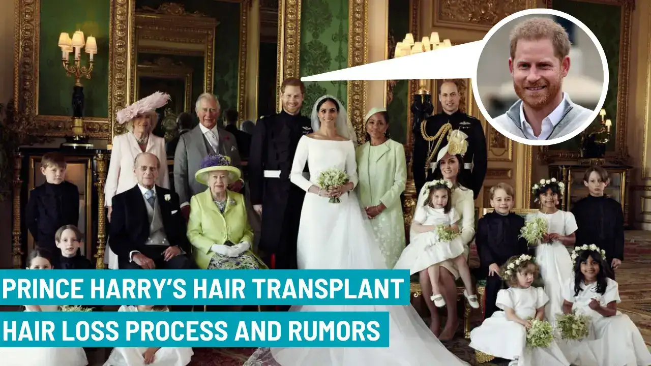 Prince Harry Hair Transplant (1) (1) Prince Harry Hair Transplant