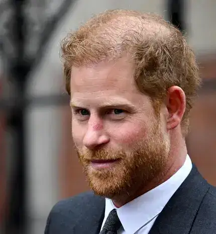 Prince Harry Hair Transplant 1 (1) Prince Harry Hair Transplant