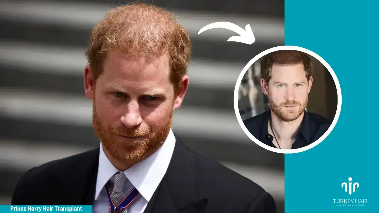 Prince Harry Hair Transplant (4) (1) Prince Harry Hair Transplant
