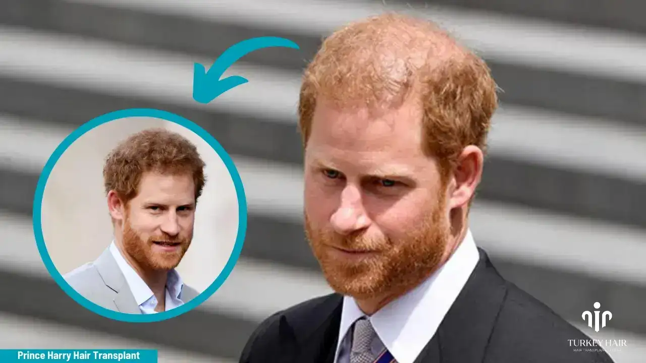Prince Harry Hair Transplant (5) (1) Prince Harry Hair Transplant