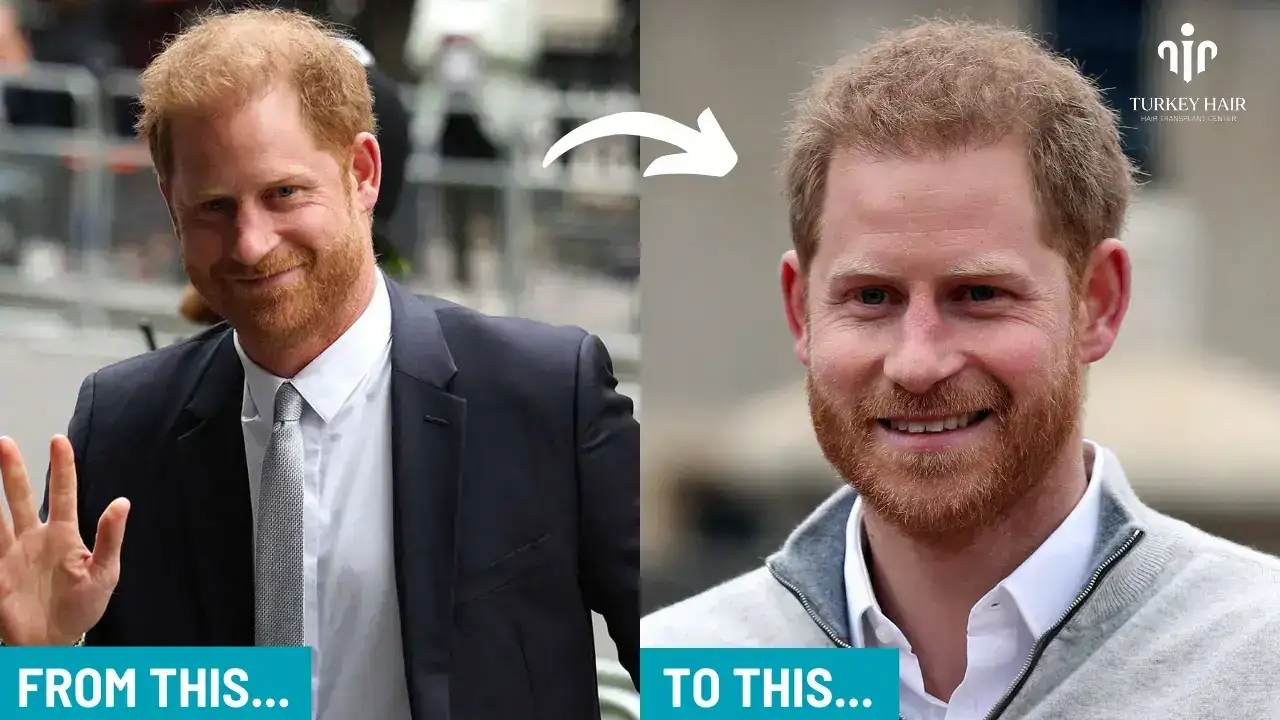 Prince Harry Hair Transplant (6) (1) (1) Prince Harry Hair Transplant