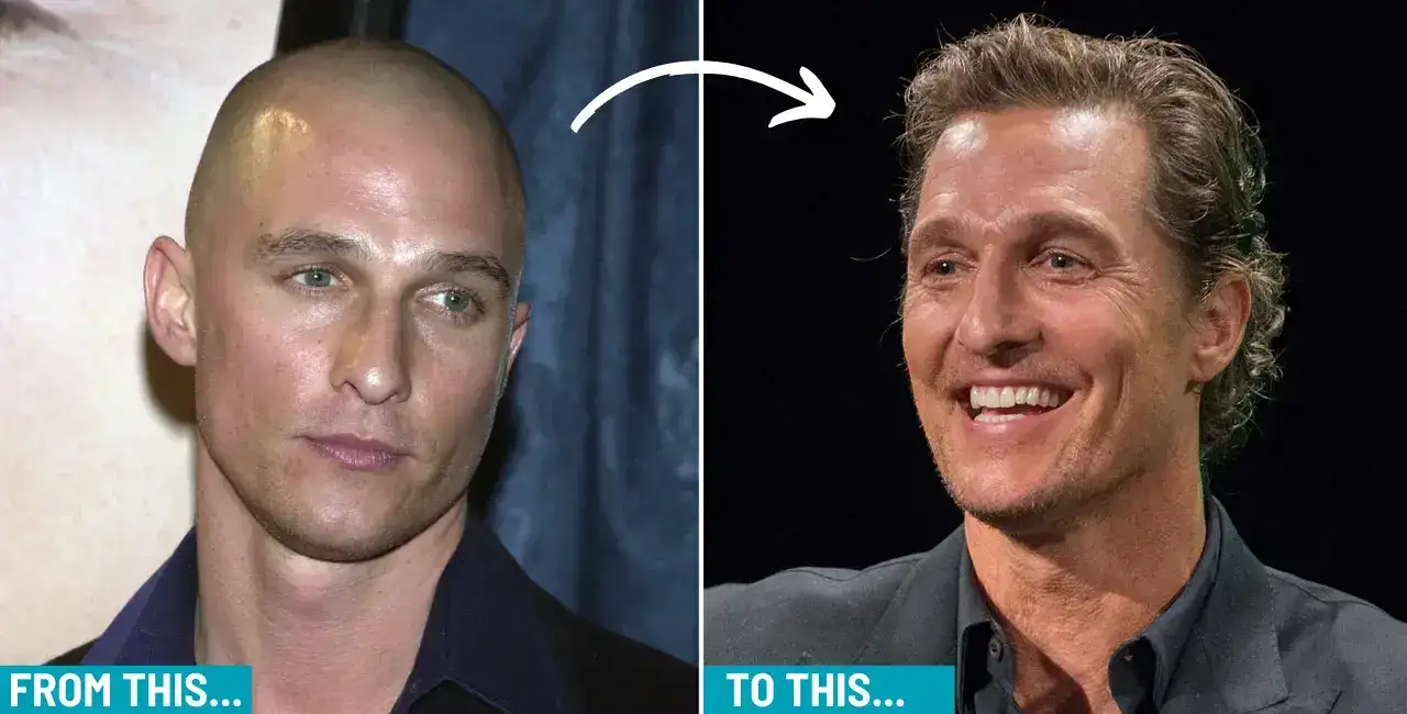 Matthew Mcconaughey Hair Transplant
