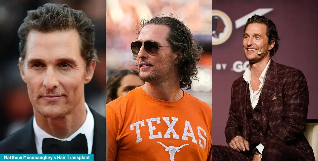 Matthew Mcconaughey Hair Transplant