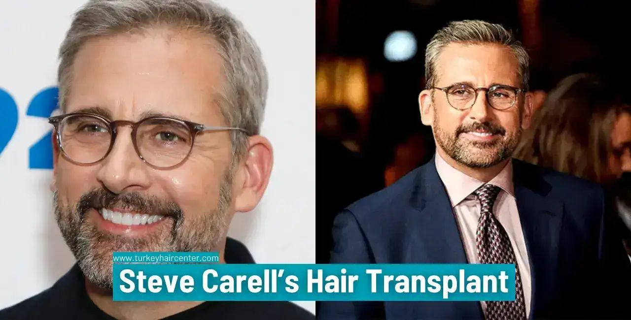 Steve Carell’s Hair Transplant