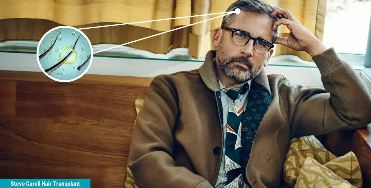 Steve Carell’s Hair Transplant