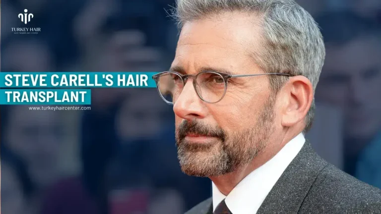 Steve Carell’s Hair Transplant
