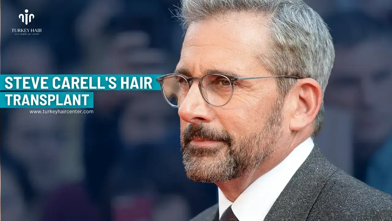 Steve Carell’s Hair Transplant