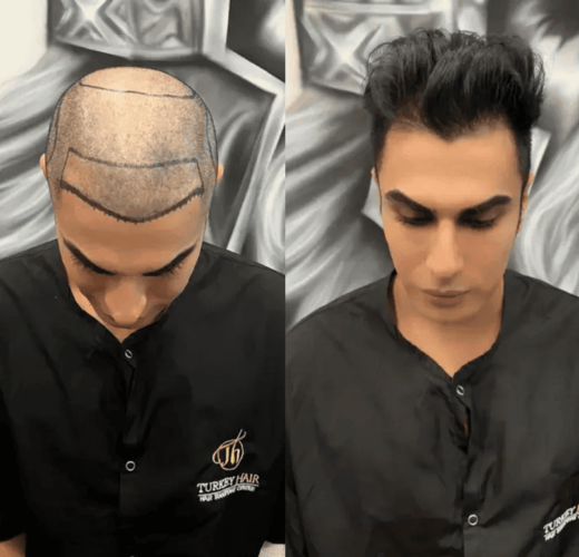 Hair Clinic Turkey