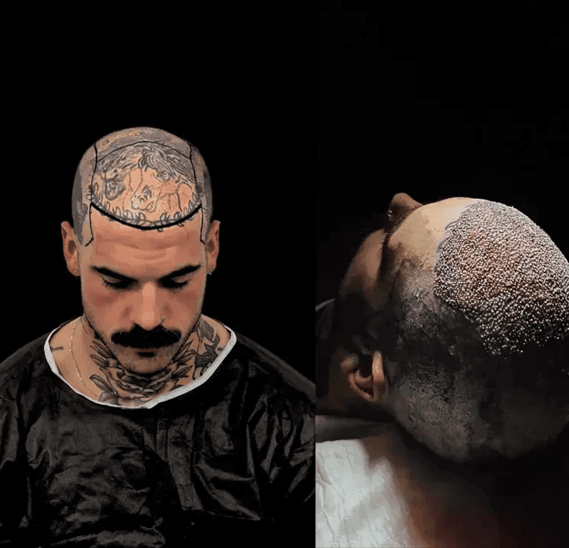 Hair Treatment Turkey
