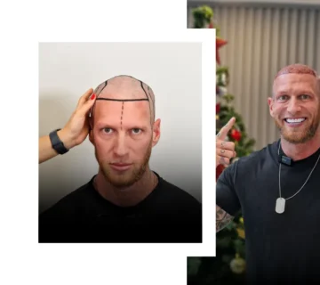Dhi Hair Transplant (3)