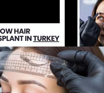 Eyebrow Transplant