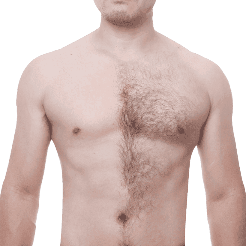 Body-Transplant-Bg11 Body Hair Transplant