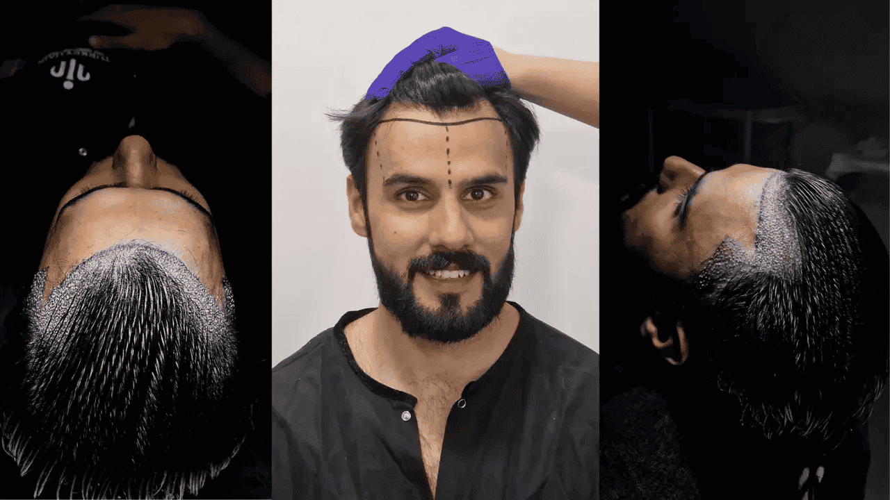 Dhi Hair Transplant