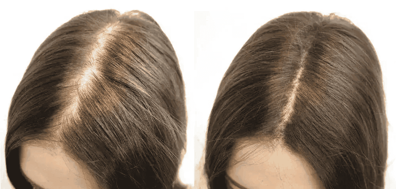Hair Transplant For Women