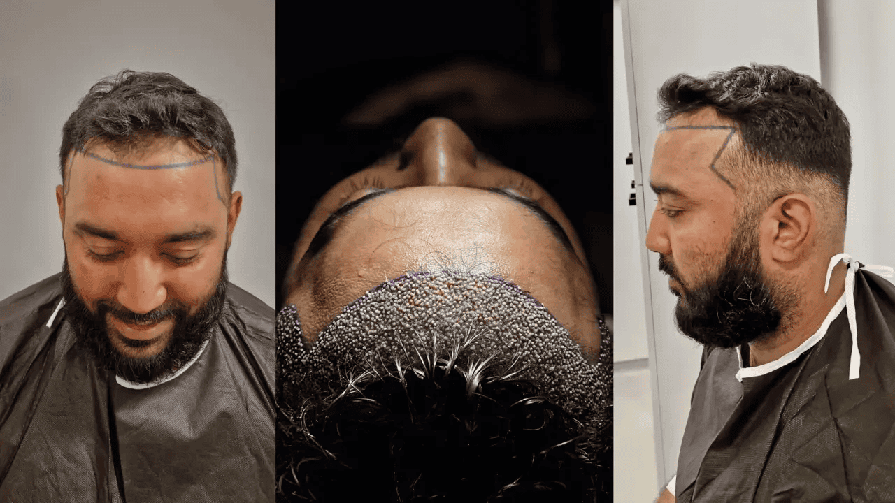 No Shave Hair Transplant Turkey
