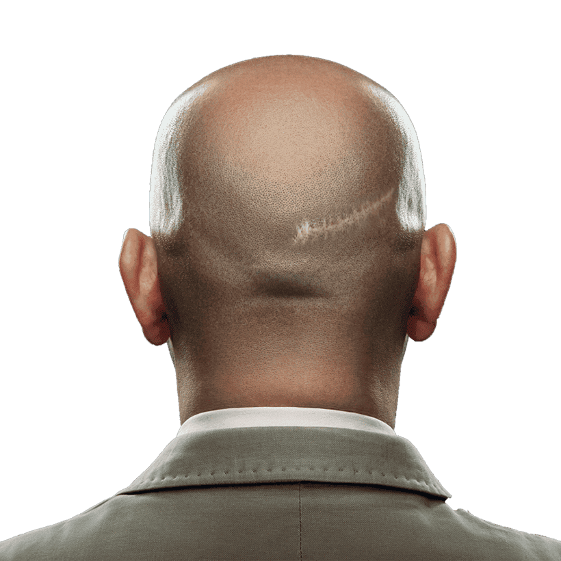 Celebrity Hair Transplant Scar Celebrity Hair Transplant Scar