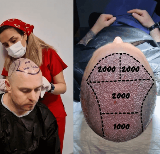 Turkey Hair Center World-Record