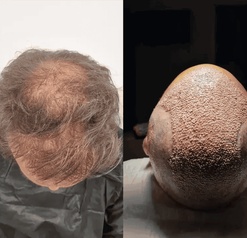 Turkey Hair Center World Record