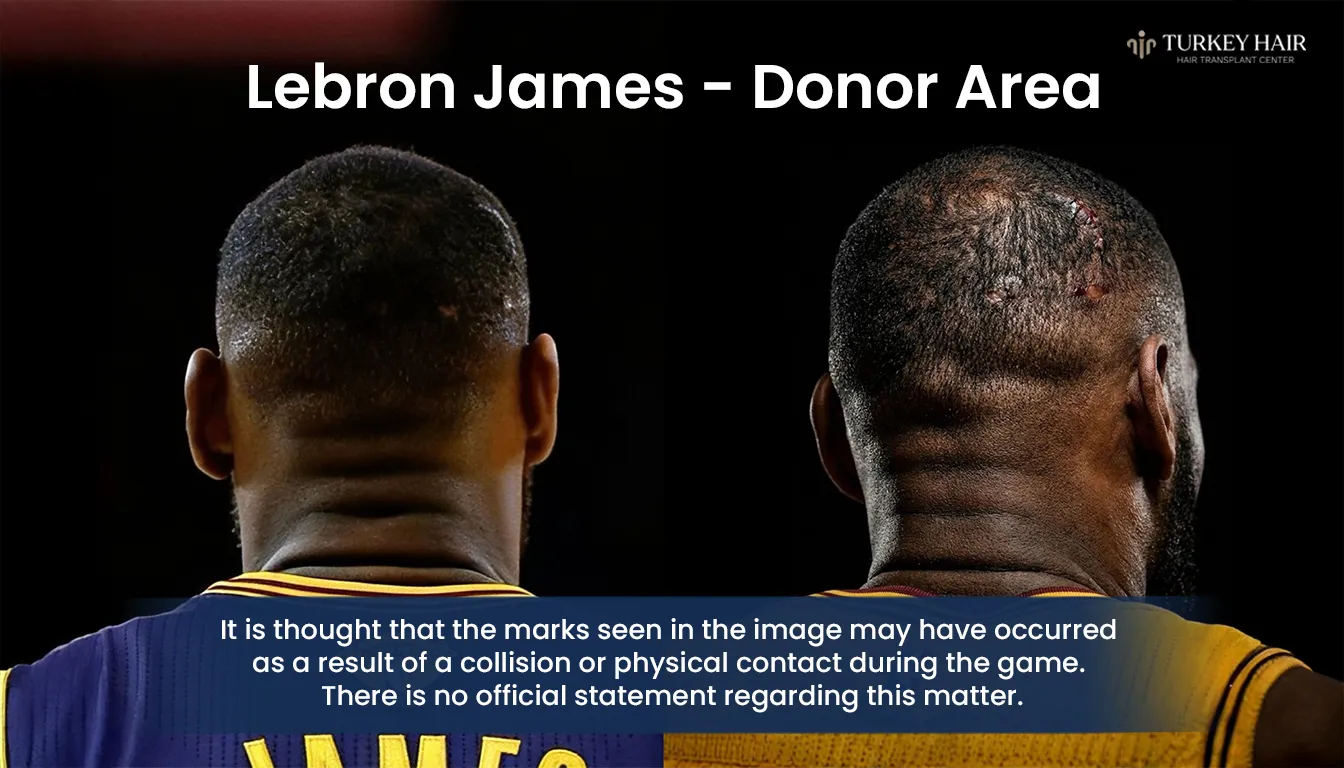 Donor Area At Back Of Head Examined For Possible Hair Transplant Extraction Marks
