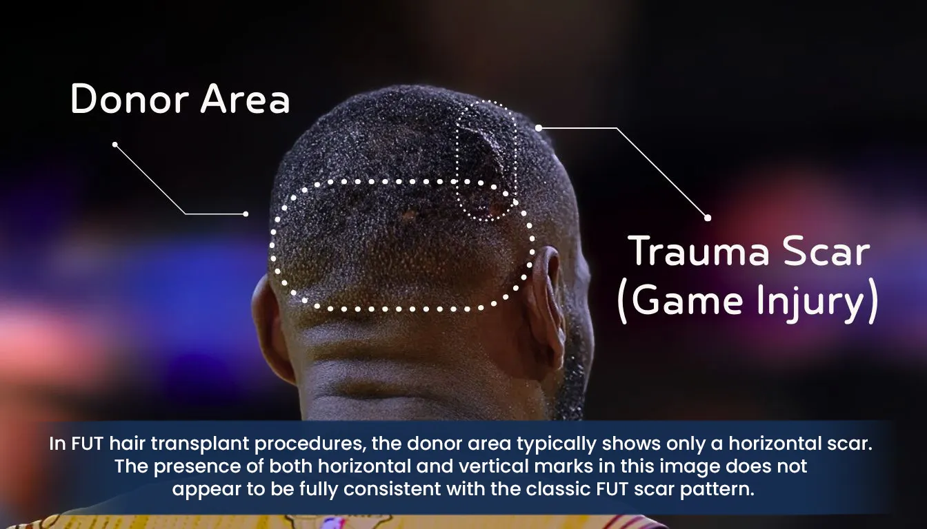 Back Of Head Scar Analysis Comparing Trauma Injury And Fue Fut Hair Transplant Scars