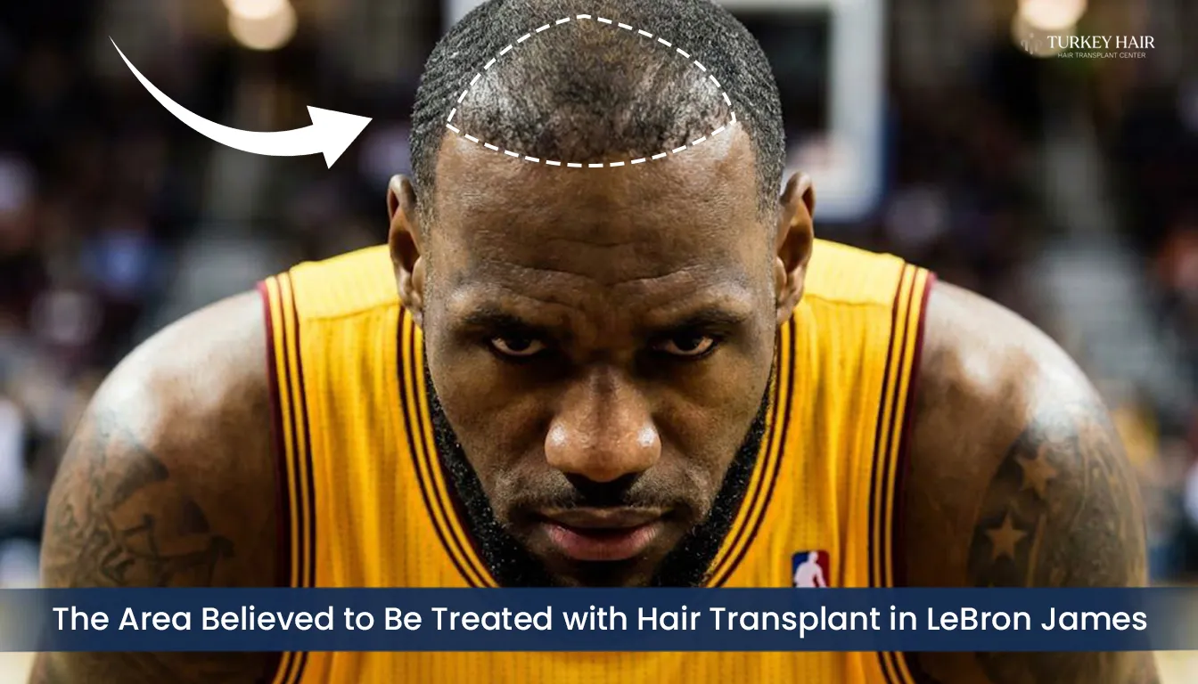 Frontal Hairline Restoration Area Analysis In Lebron James Hair Transplant Case