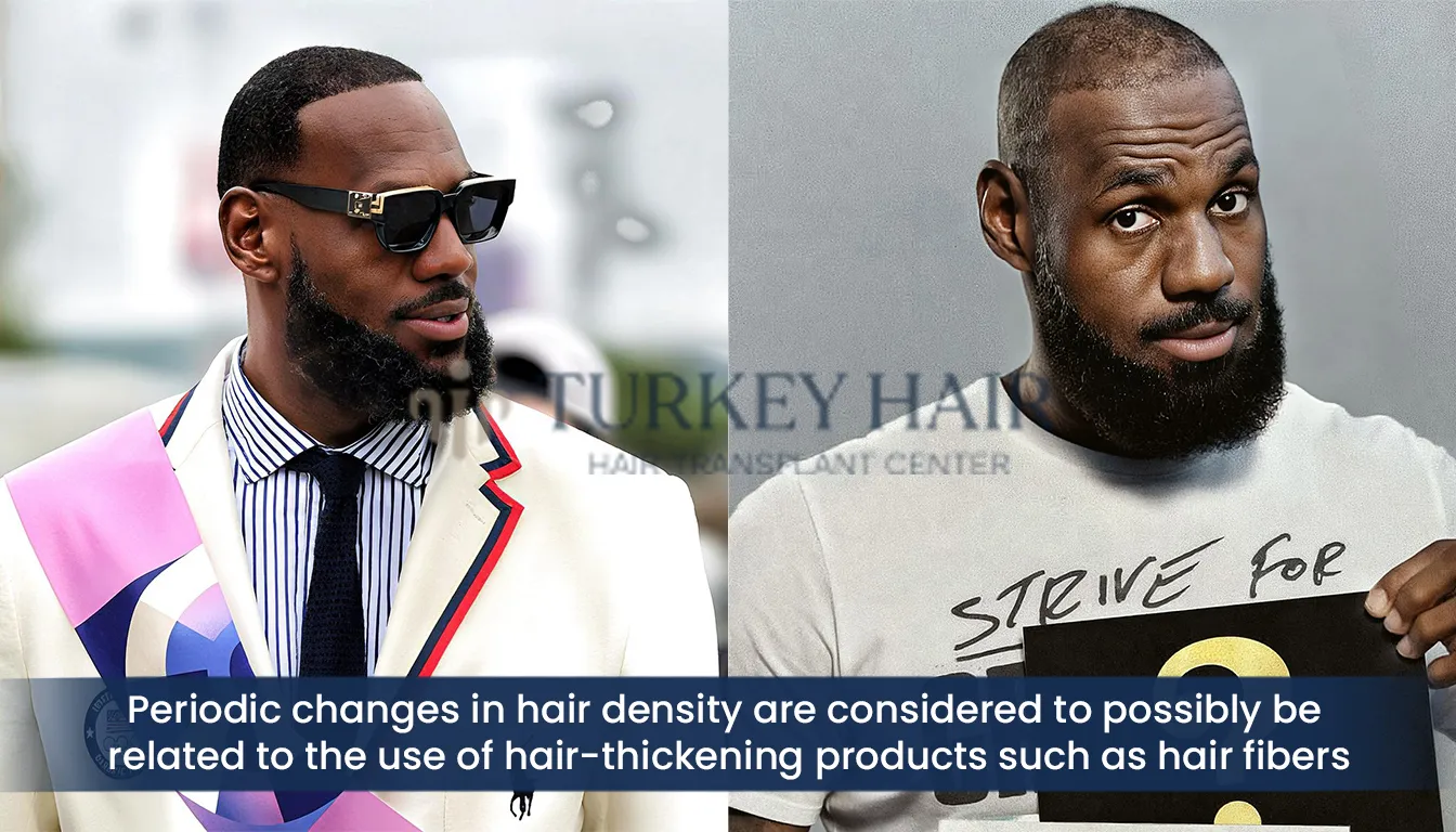 Lebron James Hair Density Changes And Thinning Areas Sparking Hair Transplant Speculation