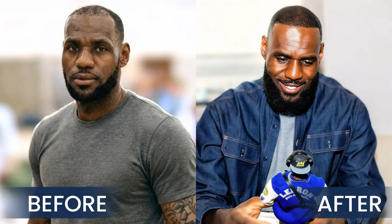 On Court Comparison Of Lebron James Hairline Before And After Hair Restoration