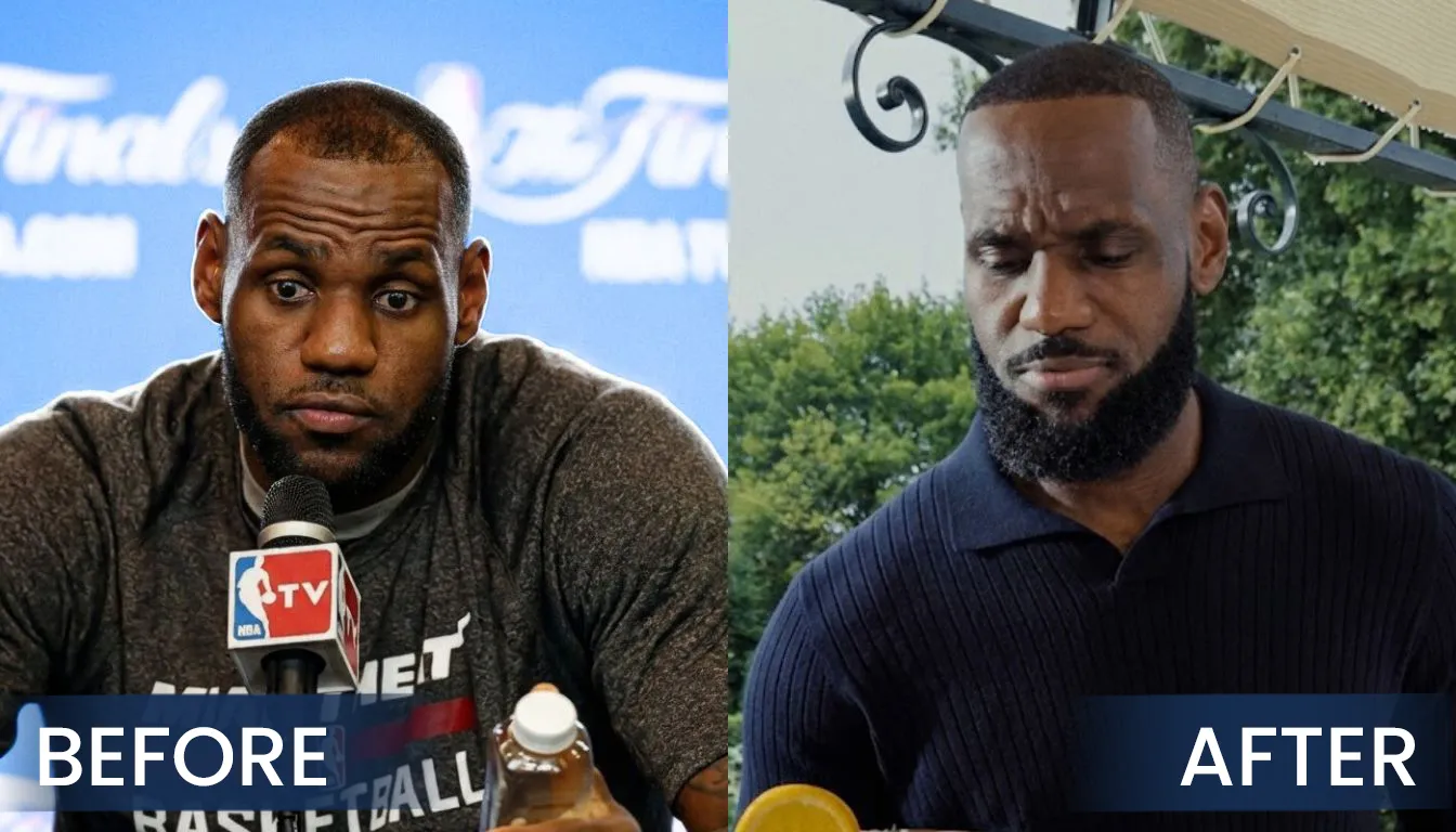 Real Life Public Appearance Before And After Hair Transplant Comparison Of Lebron James