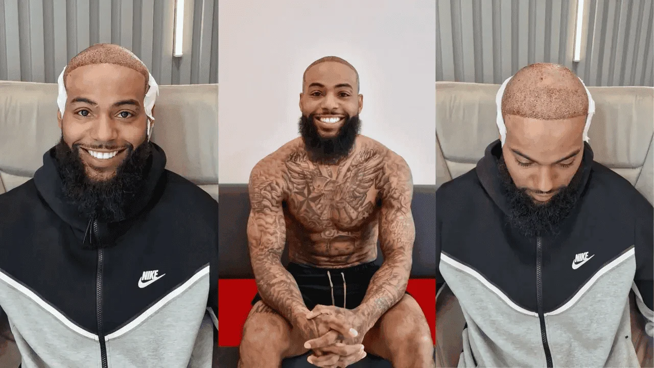 After-Afro-Hair-Transplant After Afro Hair Transplant