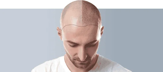 Fue Hair Transplant Img2