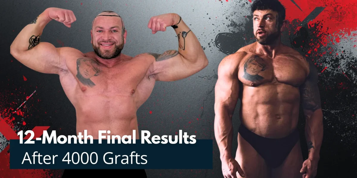 12-Month Final Results After 4000 Grafts