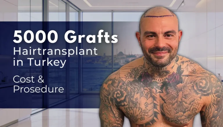 5000 Grafts Hair Transplant Turkey – Cost   Before And After