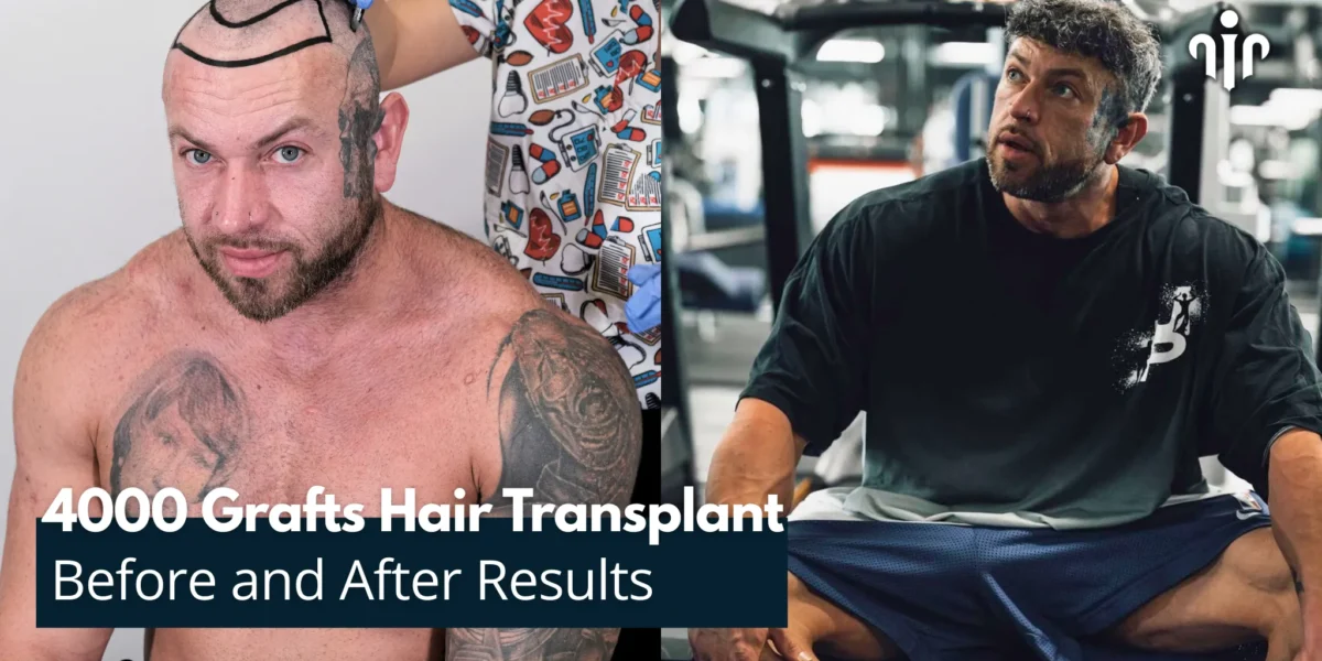 Before And After Results Of 4000 Grafts Hair Transplant