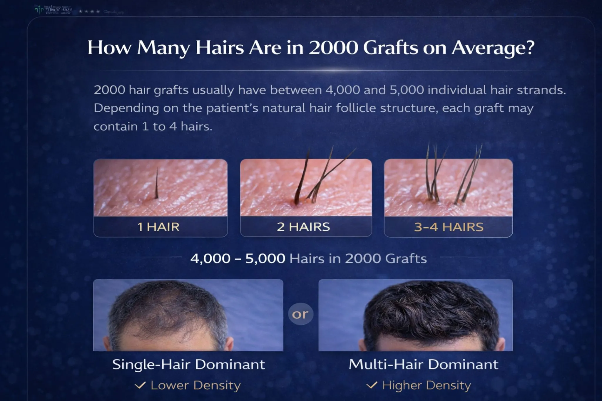 How Many Hairs Are In 2000 Grafts On Average
